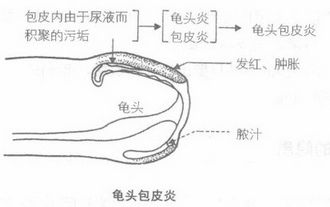 包皮龟头炎有效zl方法