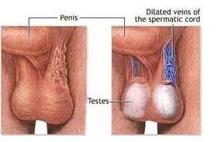 苏州男科医院治疗睾丸炎