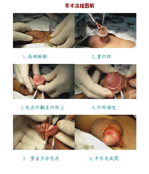 成都目前最先进的包皮手术