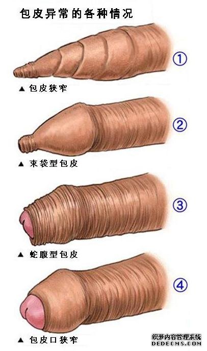 【包皮过长】包皮过长的标准是什么