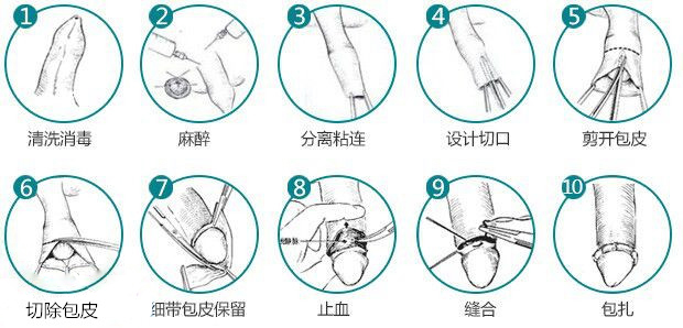 成都目前较**的包皮手术