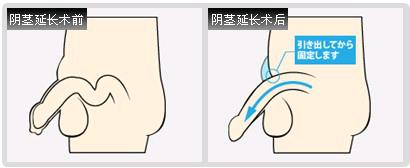 阴茎延长的方法