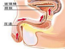 【阴茎延长】成都做阴茎延长那个医院好