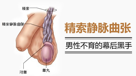 男性精索静脉曲张治疗 为什么男性睾丸有时会有下坠感?