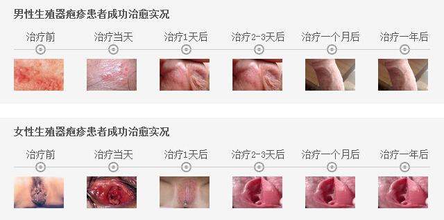 患上生殖器疱疹有什么症状?