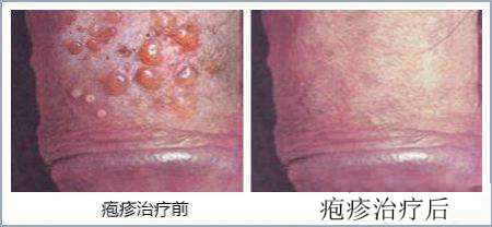 生殖器疱疹的治疗方法